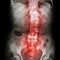 Spondylosis and Scoliosis ( film x-ray lumbar - sacrum spine show crooked spine ) ( old patient ) ( Spine Healthcare )