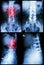 Spondylosis and Spondylolisthesis