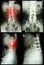 Spondylosis and Spondylolisthesis