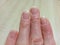 Spring avitaminosis of nails