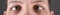 squint strabismus in a man panorama close-up