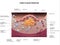 Stable plaque formation, Atherosclerosis