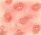 Stage 3 of development of acne. Inflamed skin with scars, acne and pimples. The texture of inflamed skin, and acne and