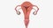 Stage I endometrial cancer begins in the endometrium and spreads to the myometrium of the uterus