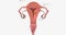 Stage I endometrial cancer begins in the endometrium and spreads to the myometrium of the uterus