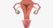 Stage I endometrial cancer begins in the endometrium and spreads to the myometrium of the uterus