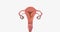 Stage II endometrial cancer is characterized by tumor spread to the uterine cervix