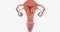 Stage II endometrial cancer is characterized by tumor spread to the uterine cervix