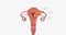 During stage III endometrial cancer, the tumor spreads outside of the uterus