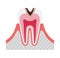 The stage of tooth decay illustration / Decay in dentin