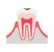 The stage of tooth decay illustration/ Decay in enamel