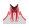 The stage of tooth decay illustration / Decay in pulp