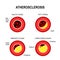 Stages of atherosclerosis.