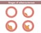 Stages of atherosclerosis. Development of atherosclerosis in the lumen of the vessel