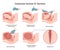 Stages of baby birth with caesarean section. Fetus position during