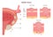 Stages of bladder cancer. Human internal organ wall with a developing