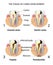 THE STAGES OF CARIES DEVELOPMENT