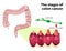 The Stages of Colorectal Cancer