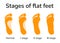 Stages of flat feet