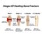 Stages Of Healing Bone Fracture. Formation of callus. The bone fracture. Infographics. Vector illustration on isolated