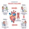 Stages of heart failure and symptoms with cardiology stroke outline diagram