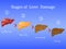 Stages of liver damage, liver disease. Healthy, fatty, liver fibrosis and cirrhosis on blue background.Vector illustratio