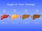 Stages of liver damage, liver disease. Healthy, fatty, liver fibrosis and cirrhosis on blue background.Vector illustratio