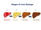 Stages of liver damage, liver injury fatty liver, liver fibrosis, liver cirrhosis