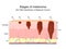 Stages of melanoma. The TNM Classification of Malignant Tumors