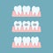 Stages of orthodontic treatment braces on teeth. Alignment of bite of teeth, dental row  with braces