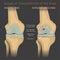 Stages of osteoarthritis of the knee