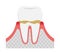 The stages of periodontitis disease illustration  / Gingivitis