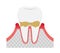 The stages of periodontitis disease illustration   / Mild periodontitis