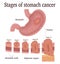 Stages of stomach cancer