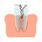 Stages of tooth decay with caries. Dentistry and oral care