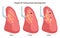 Stages of tuberculosis development. Respiratory system disease. Human lung