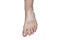 Stains from vitiligo disease on the left foot in a young Caucasian woman, isolated on a white background with a clipping path.