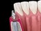 Standard abutment, dental implant and ceramic crown. Medically accurate tooth 3D illustration