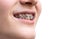 Steel dental braces on teeth of girl cutout