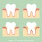 Step of periodontal disease / periodontitis / gingivitis / gum disease, dental problem