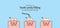 Step of tooth cavity filling cross-section structure inside toot