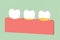 Step of tooth periodontal disease with dental plaque or tartar