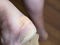 Sticking plaster closes callus on heel