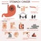 Stomach cancer eps 10