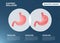 Stomach Endoscopy Gastric Balloon Inside a Stomach weight loss surgery vector illustration obesity