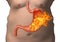 Stomach fire. excessive acidity, indigestion, stomach disease, gastric ulcer, severe abdominal pain