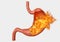 Stomach fire. excessive acidity, indigestion, stomach disease, gastric ulcer, severe abdominal pain