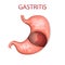 Stomach, gastritis