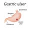 Stomach ulcer affected. Gastric ulcer. Vector