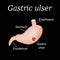 Stomach ulcer affected. Gastric ulcer. Vector illustration on a black background